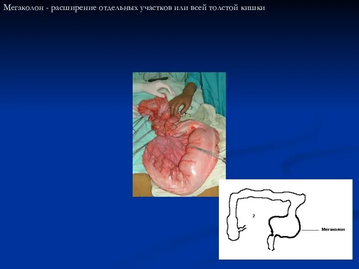 Мегаколон - расширение отдельных участков или всей толстой кишки