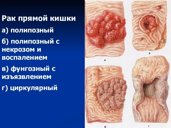 Рак прямой кишки а) полипозный б) полипозный с некрозом и воспалением