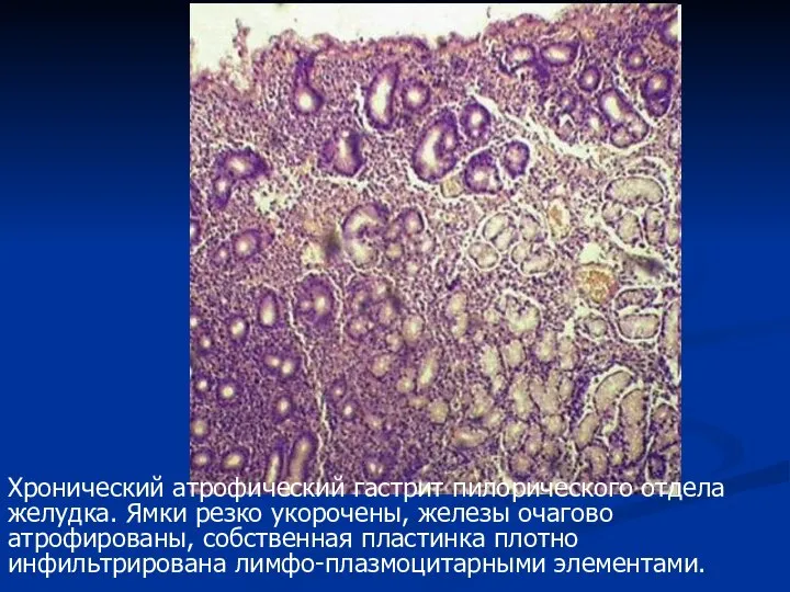 Хронический атрофический гастрит пилорического отдела желудка. Ямки резко укорочены, железы очагово