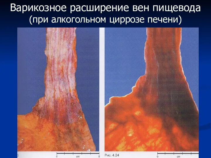 Варикозное расширение вен пищевода (при алкогольном циррозе печени)