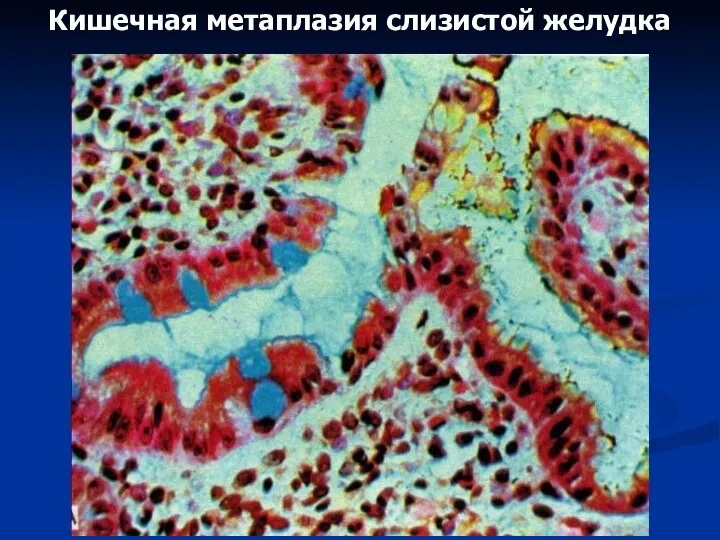 Кишечная метаплазия слизистой желудка