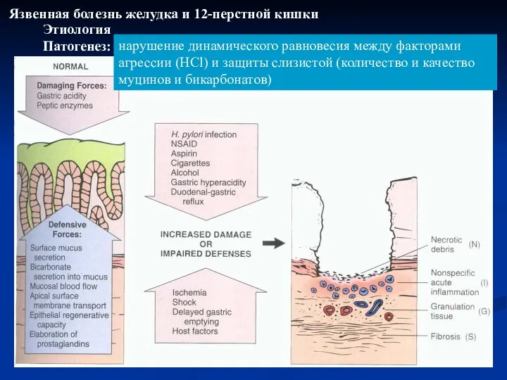 Этиология Патогенез: Язвенная болезнь желудка и 12-перстной кишки нарушение динамического равновесия