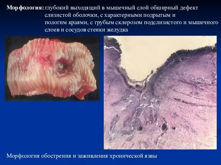 глубокий выходящий в мышечный слой обширный дефект слизистой оболочки, с характерными