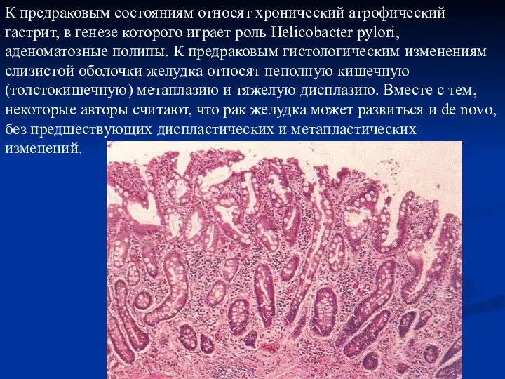 К предраковым состояниям относят хронический атрофический гастрит, в генезе которого играет