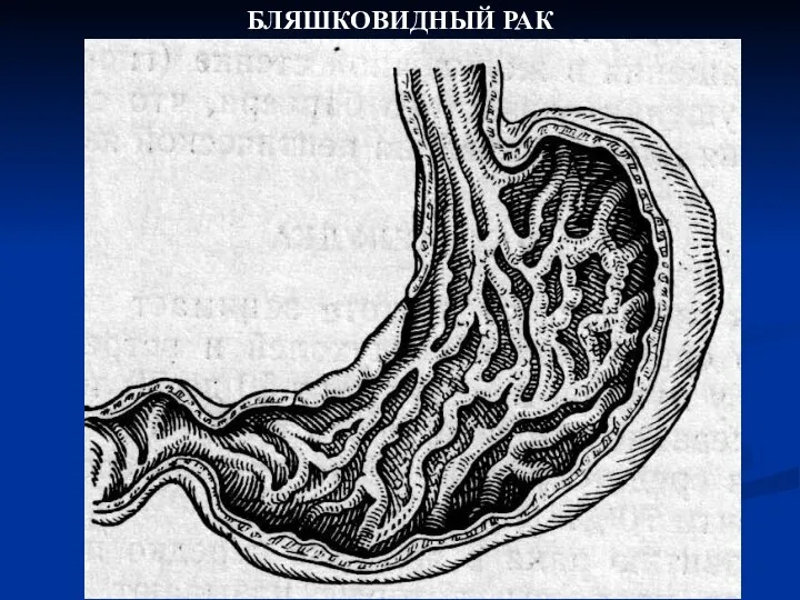 БЛЯШКОВИДНЫЙ РАК