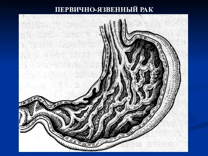 ПЕРВИЧНО-ЯЗВЕННЫЙ РАК