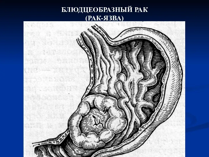 БЛЮДЦЕОБРАЗНЫЙ РАК (РАК-ЯЗВА)