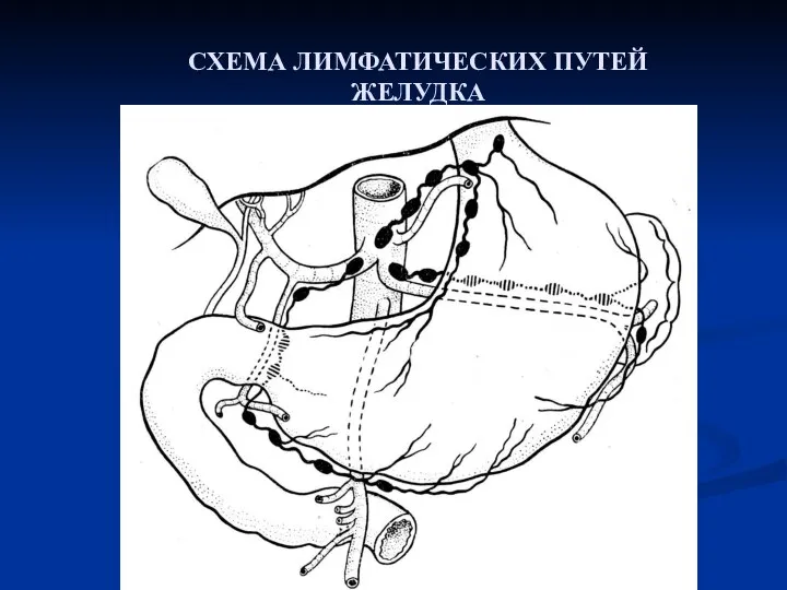 СХЕМА ЛИМФАТИЧЕСКИХ ПУТЕЙ ЖЕЛУДКА