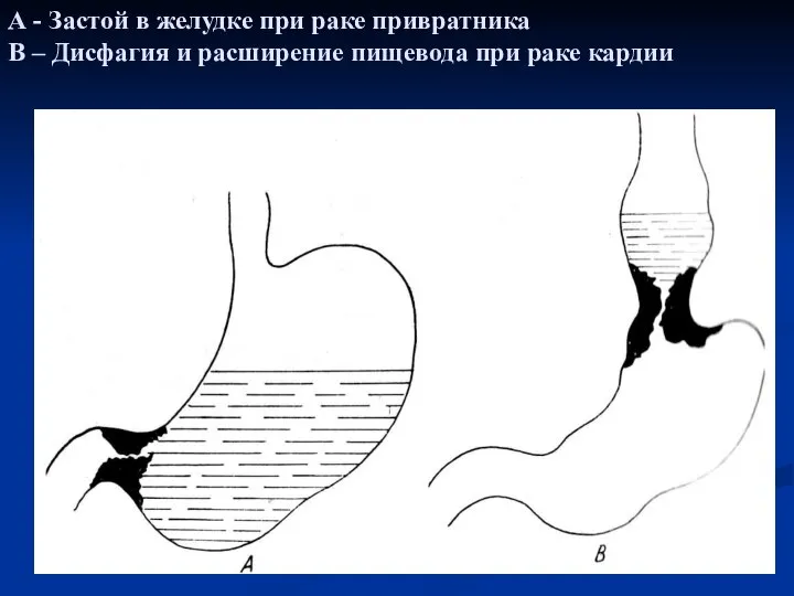 А - Застой в желудке при раке привратника В – Дисфагия