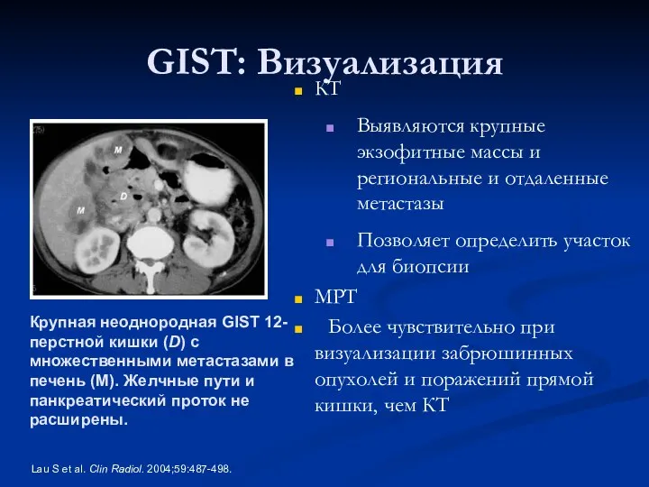 GIST: Визуализация Lau S et al. Clin Radiol. 2004;59:487-498. КТ Выявляются