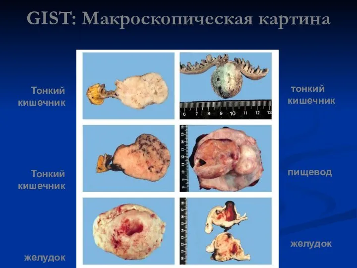 GIST: Макроскопическая картина Тонкий кишечник Тонкий кишечник желудок тонкий кишечник пищевод желудок