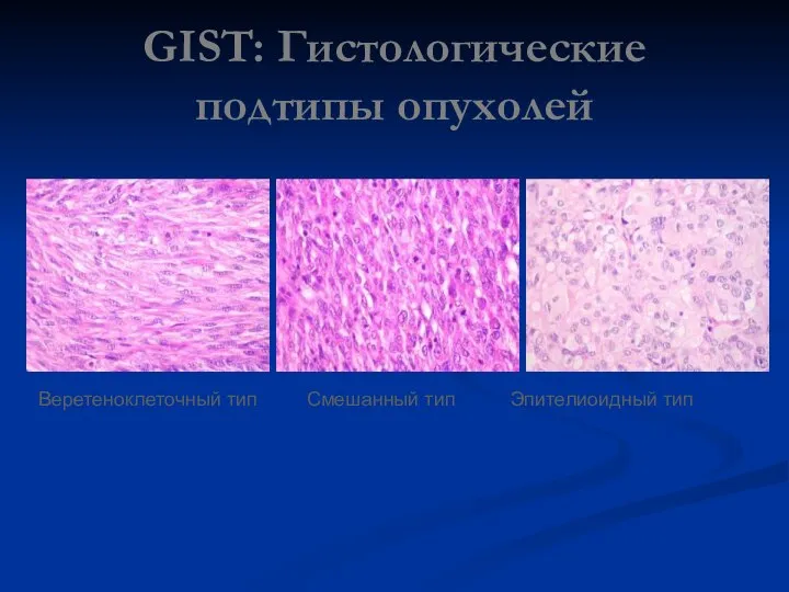 GIST: Гистологические подтипы опухолей Веретеноклеточный тип Смешанный тип Эпителиоидный тип