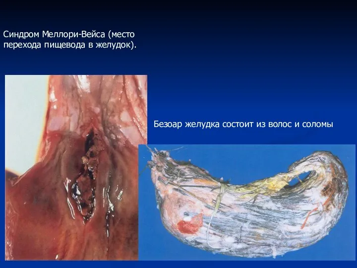 Безоар желудка состоит из волос и соломы Синдром Меллори-Вейса (место перехода пищевода в желудок).