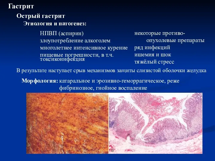 В результате наступает срыв механизмов защиты слизистой оболочки желудка Гастрит Этиология