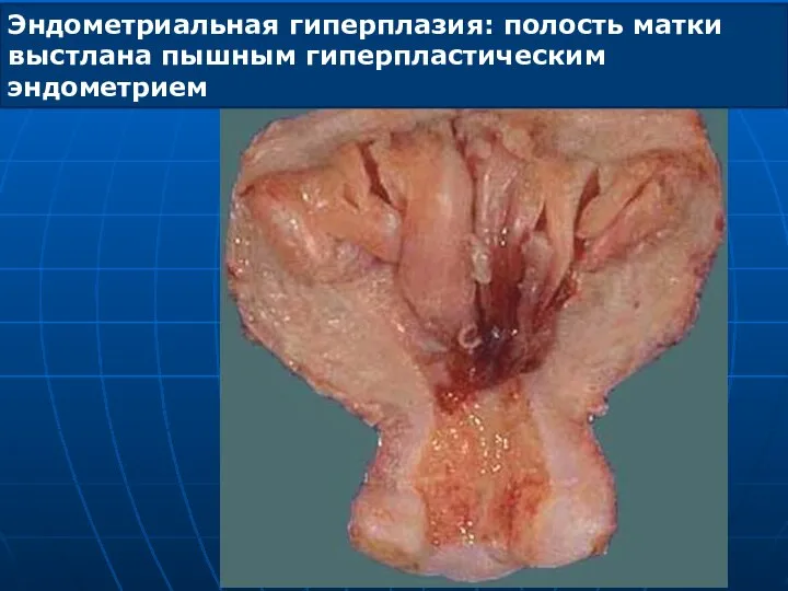 Эндометриальная гиперплазия: полость матки выстлана пышным гиперпластическим эндометрием