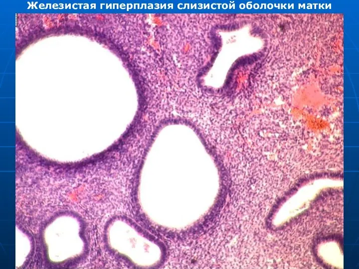 Железистая гиперплазия слизистой оболочки матки