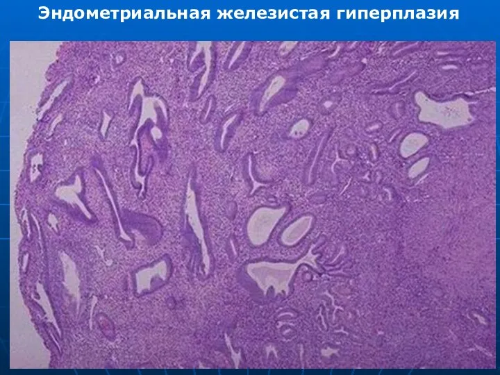 Эндометриальная железистая гиперплазия