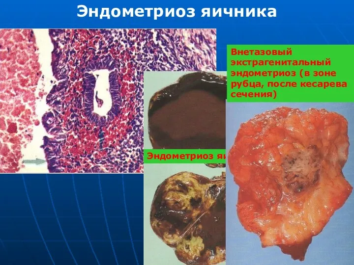 Эндометриоз яичника Эндометриоз яичника Внетазовый экстрагенитальный эндометриоз (в зоне рубца, после кесарева сечения)