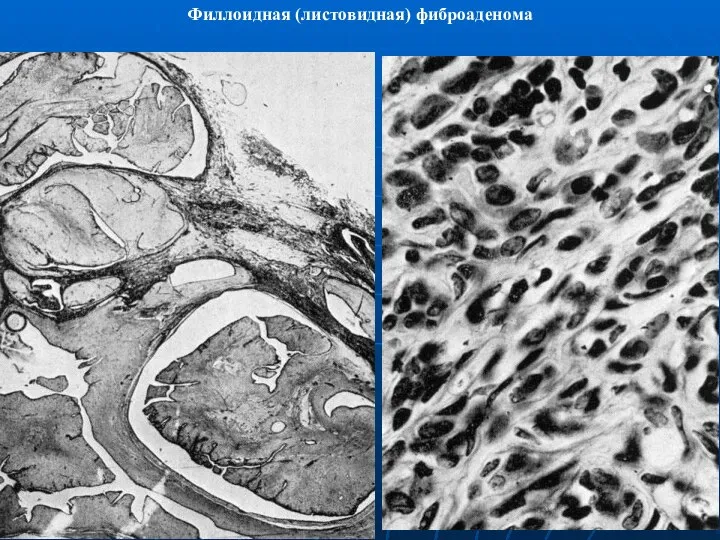 Филлоидная (листовидная) фиброаденома