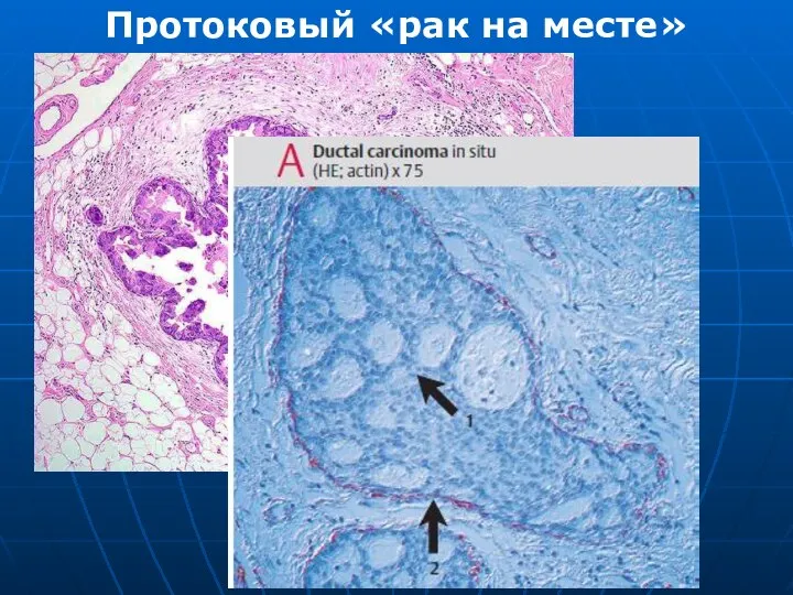 Протоковый «рак на месте»