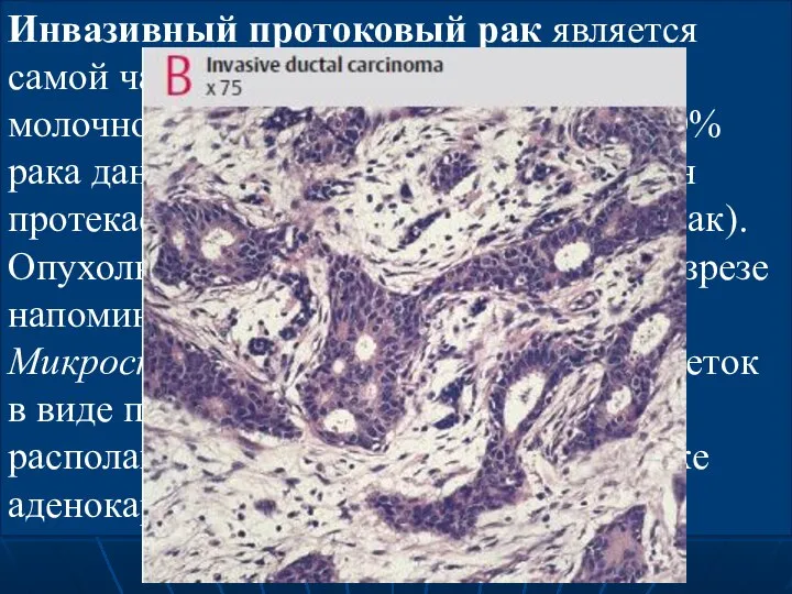 Инвазивный протоковый рак является самой частой формой инвазивного рака молочной железы,