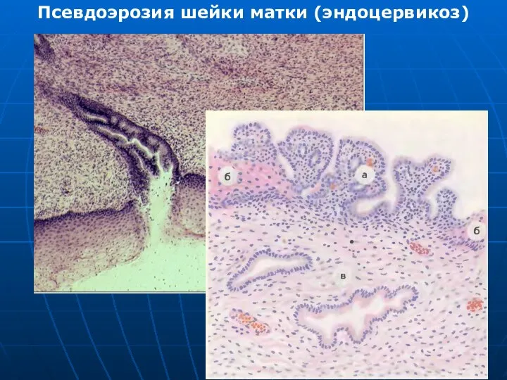 Псевдоэрозия шейки матки (эндоцервикоз)