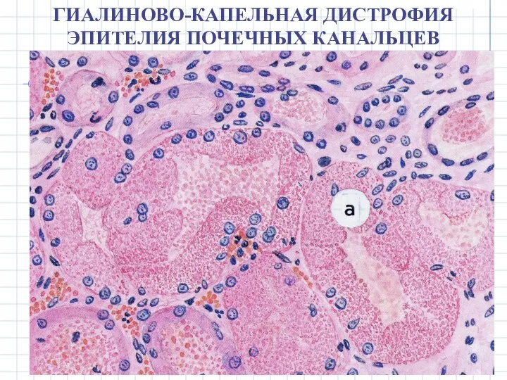 ГИАЛИНОВО-КАПЕЛЬНАЯ ДИСТРОФИЯ ЭПИТЕЛИЯ ПОЧЕЧНЫХ КАНАЛЬЦЕВ