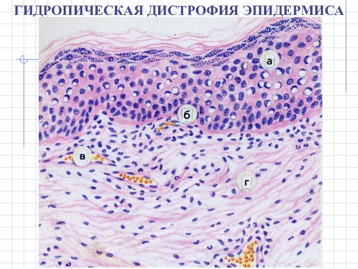 ГИДРОПИЧЕСКАЯ ДИСТРОФИЯ ЭПИДЕРМИСА