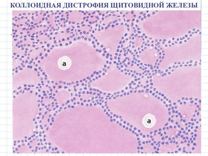 КОЛЛОИДНАЯ ДИСТРОФИЯ ЩИТОВИДНОЙ ЖЕЛЕЗЫ