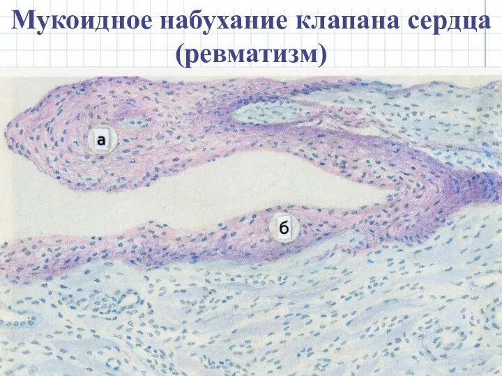 Мукоидное набухание клапана сердца (ревматизм)