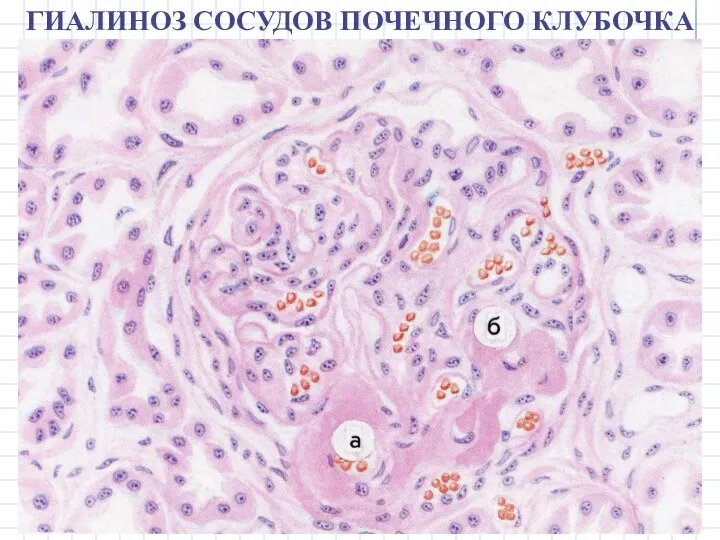 ГИАЛИНОЗ СОСУДОВ ПОЧЕЧНОГО КЛУБОЧКА
