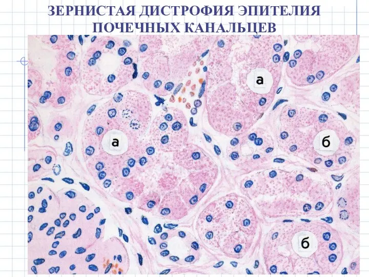 ЗЕРНИСТАЯ ДИСТРОФИЯ ЭПИТЕЛИЯ ПОЧЕЧНЫХ КАНАЛЬЦЕВ