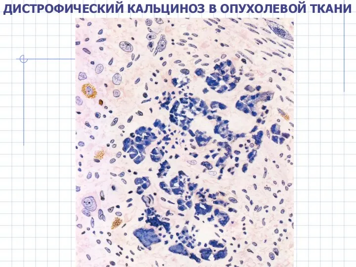 ДИСТРОФИЧЕСКИЙ КАЛЬЦИНОЗ В ОПУХОЛЕВОЙ ТКАНИ