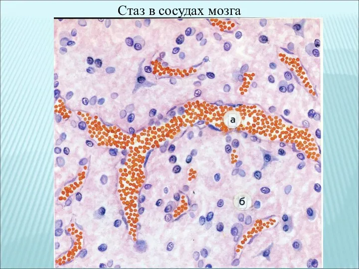 Стаз в сосудах мозга