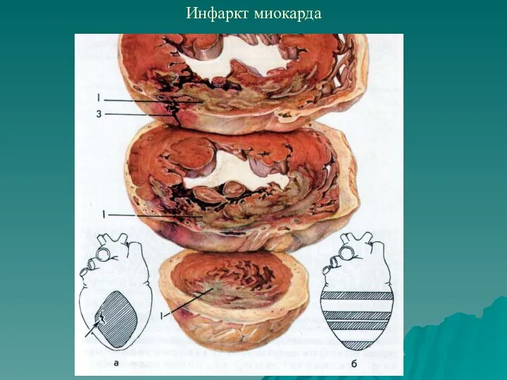 Инфаркт миокарда