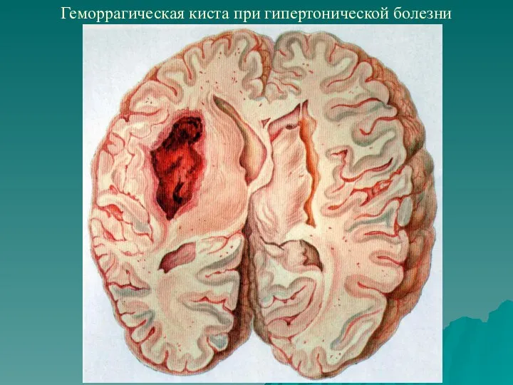 Геморрагическая киста при гипертонической болезни