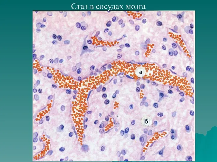 Стаз в сосудах мозга
