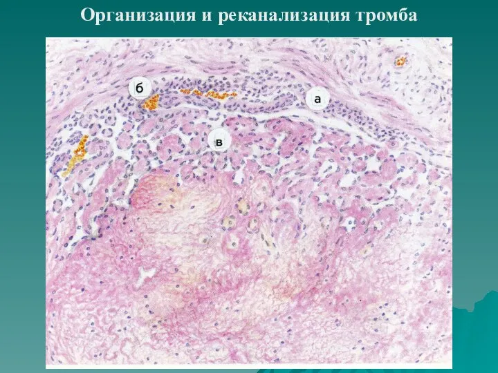 Организация и реканализация тромба