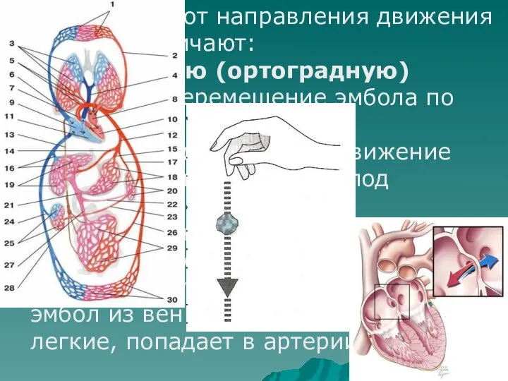 В зависимости от направления движения эмбола различают: Обыкновенную (ортоградную) эмболию (перемещение