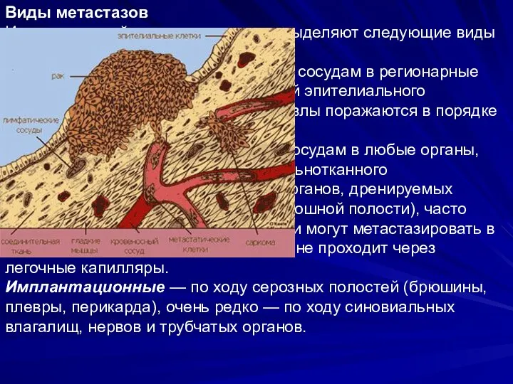 Виды метастазов Исходя из путей метастазирования, выделяют следующие виды метастазов: Лимфогенные