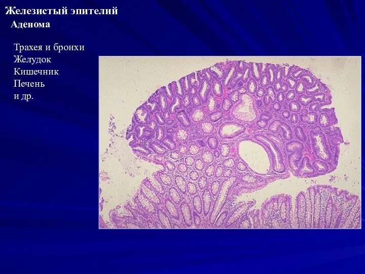 Железистый эпителий Трахея и бронхи Желудок Кишечник Печень и др. Аденома