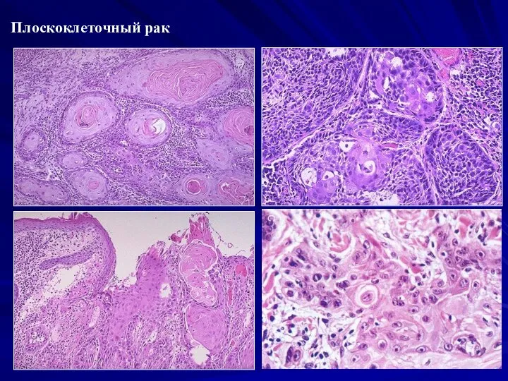 Плоскоклеточный рак