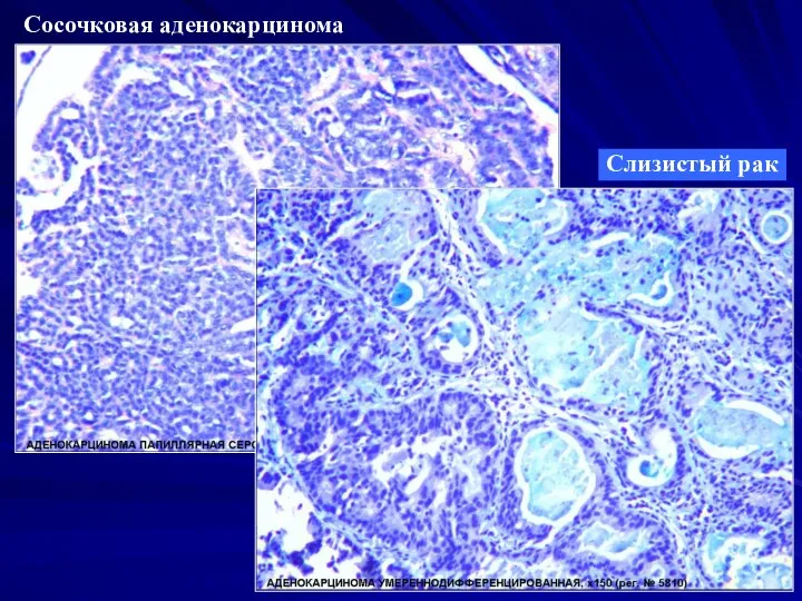 Сосочковая аденокарцинома Слизистый рак