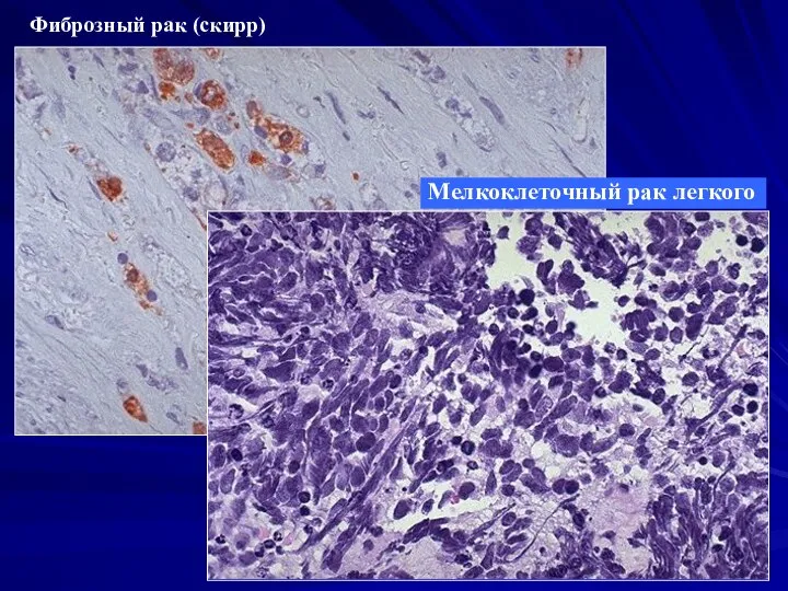 Фиброзный рак (скирр) Мелкоклеточный рак легкого