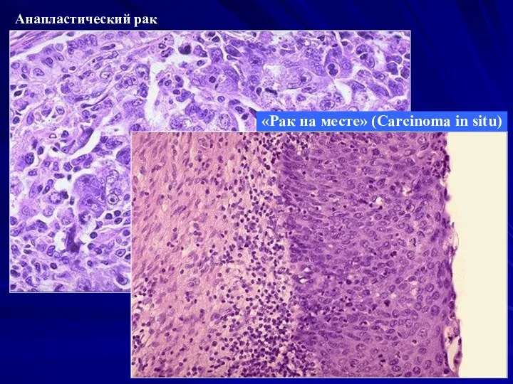 Анапластический рак «Рак на месте» (Carcinoma in situ)