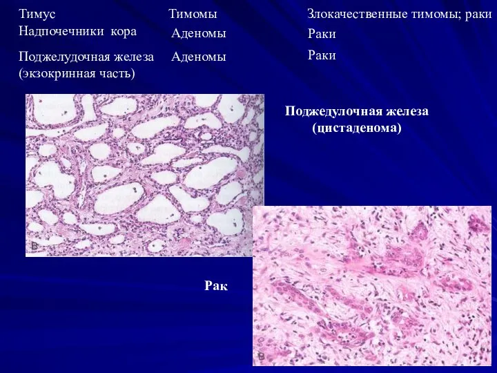 Тимус Тимомы Злокачественные тимомы; раки Раки Поджедулочная железа (цистаденома) Рак Поджелудочная