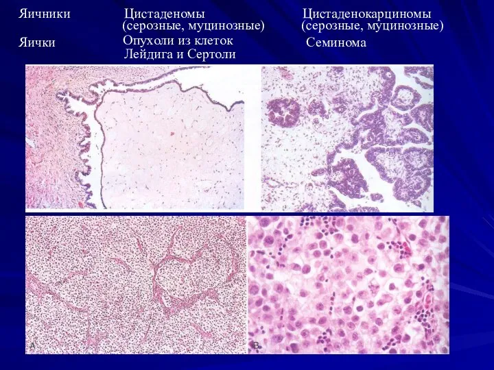 Яичники Цистаденомы Лейдига и Сертоли Цистаденокарциномы Опухоли из клеток Яички Семинома (серозные, муцинозные) (серозные, муцинозные)