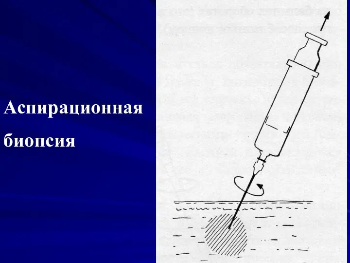 Аспирационная биопсия