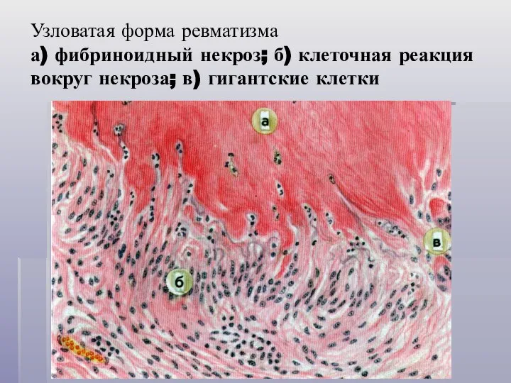 Узловатая форма ревматизма а) фибриноидный некроз; б) клеточная реакция вокруг некроза; в) гигантские клетки