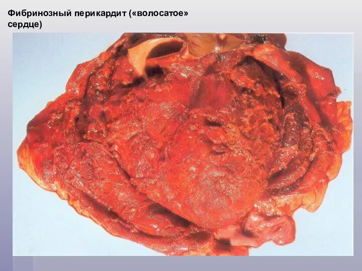 Фибринозный перикардит («волосатое» сердце)